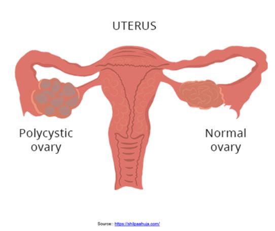 causes of PCOS