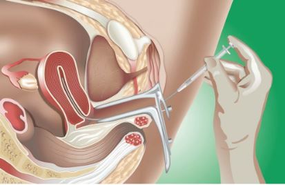 Is Intrauterine Insemination Safe