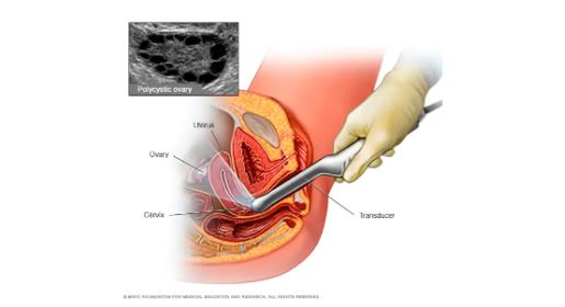 PCOD PCOS Treatment